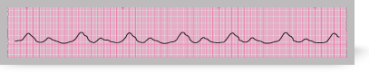 A section from an ECG rhythm strip showing agonal rhythm. 