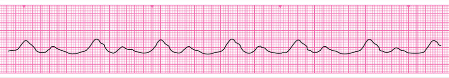 resuscitation-council-uk-advanced-life-support-escape-and-agonal