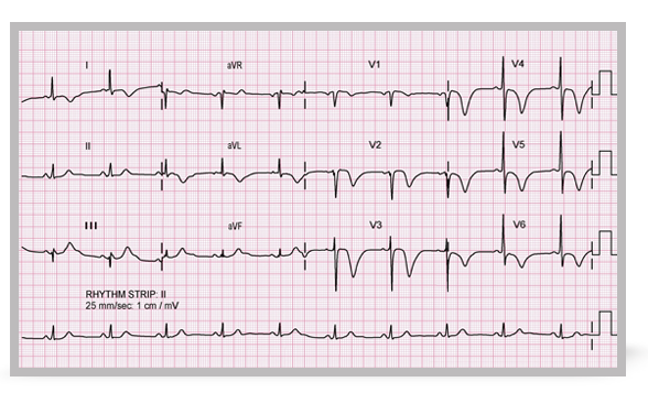 An electrocardiogram from a patient with severe and prolonged chest pain.