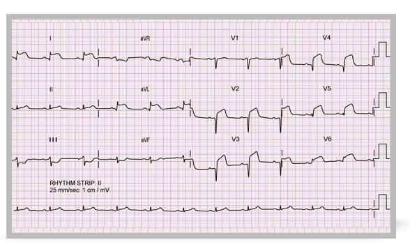 An electrocardiogram showing acute anterolateral ST-elevation infarction.
