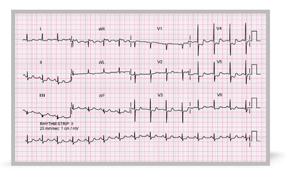 An electrocardiogram from a patient with acute coronary syndrome.