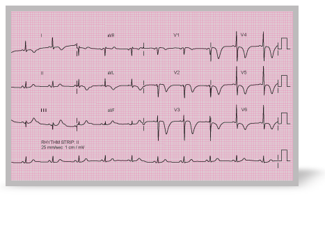 A 12-lead ECG print out.