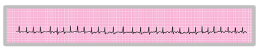 An ECG rhythm strip showing irregular QRS rhythm.