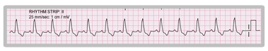 An ECG rhythm strip showing broad QRS complexes.