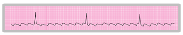 A close-up of an ECG rhythm strip that shows the saw-tooth appearance of atrial activity during atrial flutter.