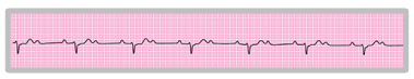 An ECG rhythm strip. There is a marker plotted at the top of all of the P waves and a label that says ‘Consistent intervals’.