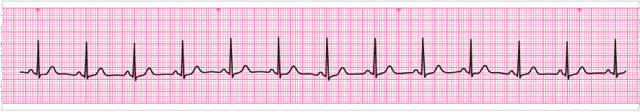 Resuscitation Council Uk Advanced Life Support How To Read A Rhythm Strip