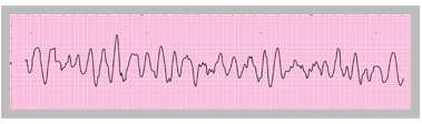 A section from an ECG rhythm strip showing ventricular fibrillation.