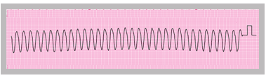 A section from an ECG rhythm strip showing monomorphic ventricular tachycardia.