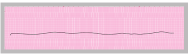 A section of an ECG rhythm strip that shows asystole. 