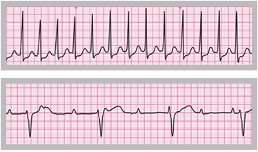 An ECG rhythm strip showing one of many rhythms that would be expected to produce a cardiac output. In the presence of clinical cardiac arrest, any such rhythm indicates the presence of PEA.