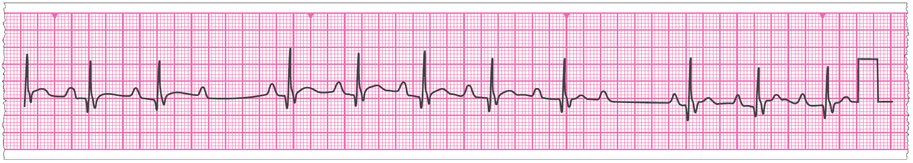 An enlarged ECG rhythm strip from patient Sunita Kundu. 