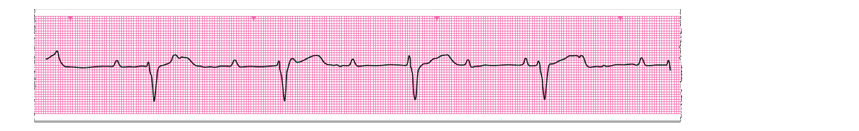 An ECG rhythm strip from Walter Smith 