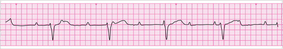 An ECG rhythm strip from Walter Smith  