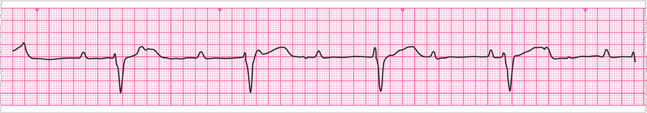 An enlarged ECG rhythm strip from patient Walter Smith. 