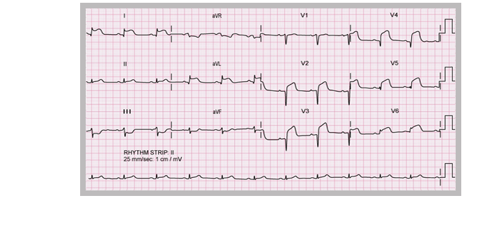 myocardial infarction ecg strip