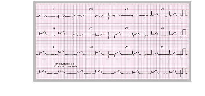 myocardial infarction ecg strip