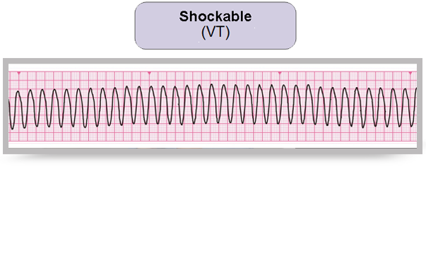 An electrocardiogram reading.