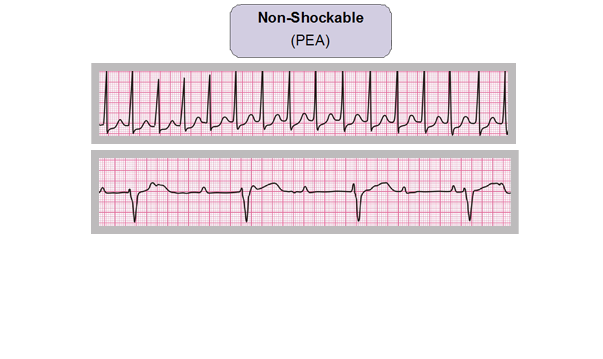 An image of two electrocardiogram readings.