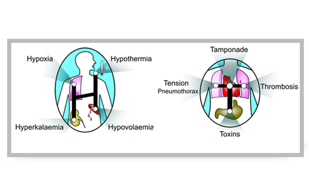 An image to show the 4 Hs and the 4 Ts: two groups of four factors for which specific treatment exists during a cardiac arrest: Hypoxia, Hypothermia, Hyperkalaemia, Hypovolaemia and Tamponade, Tension pneumothorax, Thrombosis, Toxins.