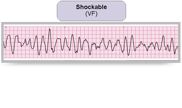 An electrocardiogram reading.