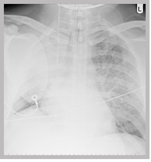 <p>A chest X-ray showing:</p><ul><li>a correctly positioned tracheal tube</li><li>a right internal jugular central line </li><li>a defibrillation patch</li><li>a collapse of the right upper lobe with loss of lung volume on the right.</li></ul><p></p>