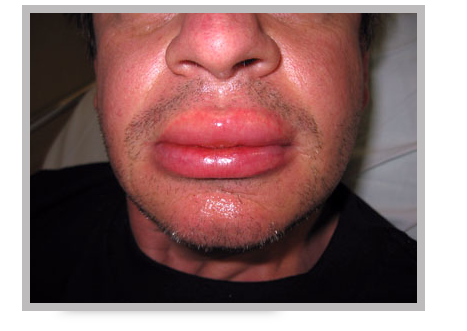 A patient suffering from anaphylaxis. 