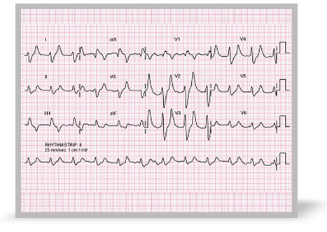 Mrs Low’s ECG.