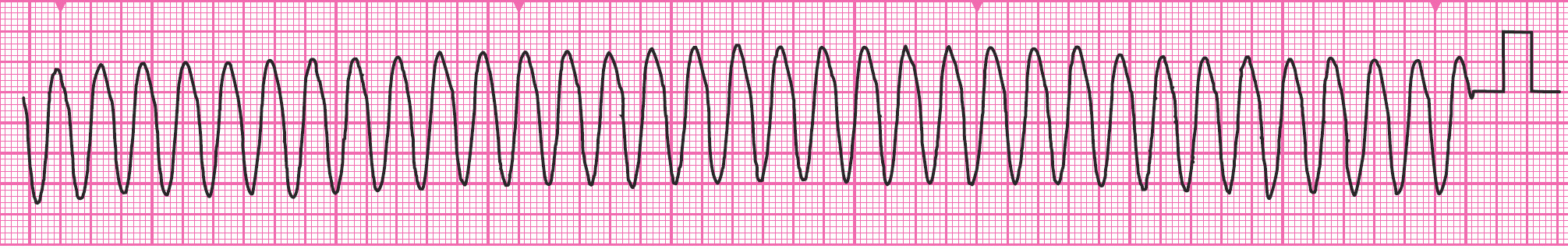 An ECG rhythm strip.