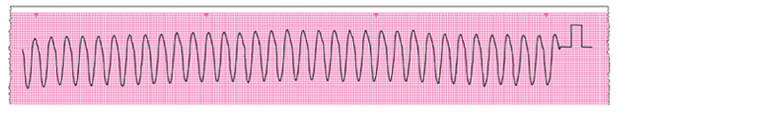 An ECG rhythm strip 