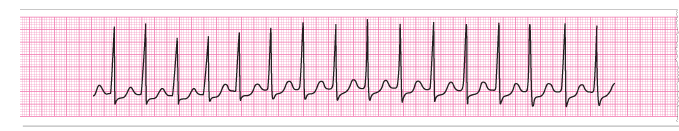 An ECG rhythm strip.