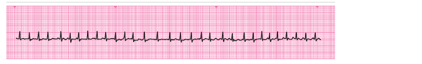 An ECG rhythm strip 