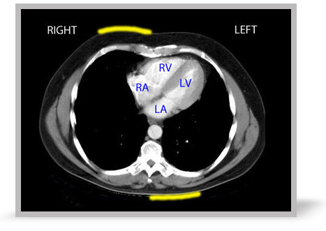 A picture of anteroposterior (AP) pad positions for external pacing.