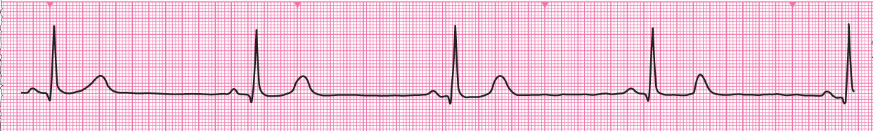 Resuscitation Council Uk Advanced Life Support Bradycardia