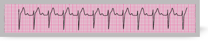 A section from an ECG rhythm strip showing<i> </i>first degree atrioventricular block.