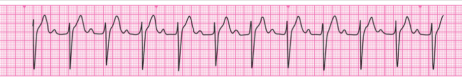 A section from an ECG rhythm strip showing<i> </i>first degree atrioventricular block. 