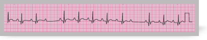 A section from an ECG rhythm strip showing Mobitz type I or Wenckebach block.