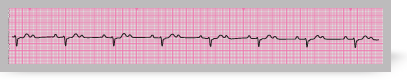 A section from an ECG rhythm strip showing Mobitz type II second degree atrioventricular block (2:1).