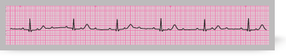 A section from an ECG rhythm strip showing Mobitz type II second degree atrioventricular block (3:1).