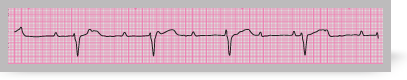 A section from an ECG rhythm strip showing third degree (complete) atrioventricular block.