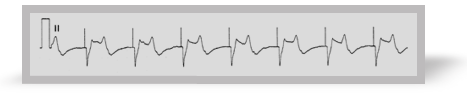 Pectoral-apical pad positions for external pacing. 