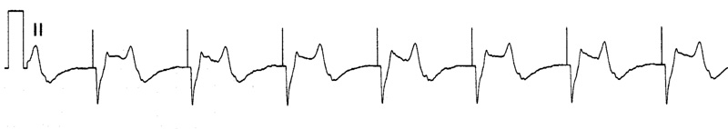Pectoral-apical pad positions for external pacing. 