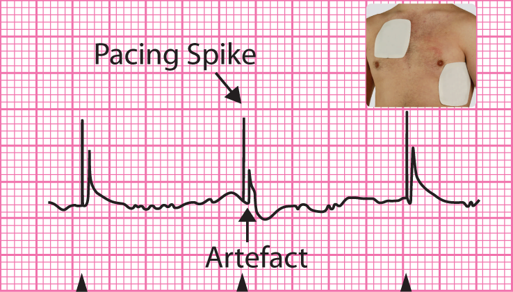 <p>Pectoral-apical pad positions for external pacing.</p><p>ECG shows ventricular capture after each pacing spike.</p>