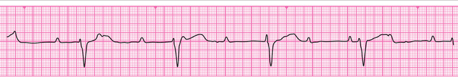 Resuscitation Council (UK) - Advanced Life Support - Interpreting the ECG